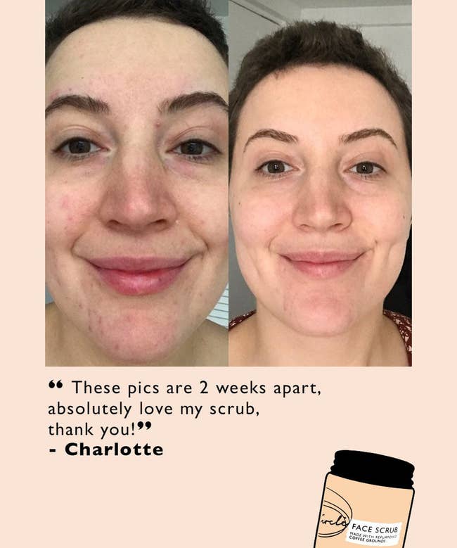 before image of reviewer with acne and then an after image taken two weeks later where they have a clean and clear face