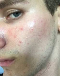 a user with acne on their face prior to using the solution 