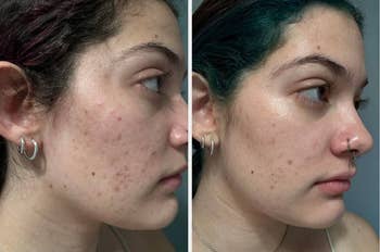 Side-by-side comparison of a person's skin before and after using the dark spot serum showing marked improvement