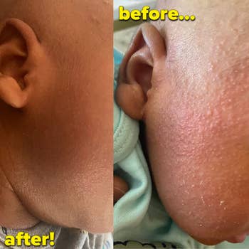 reviewer before photo showing side of child's face irritated and red, then after photo looking calm and smooth