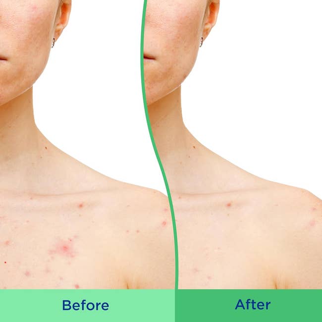 model with reddish thorax bumps and past bumps and redness improved aft utilizing the product