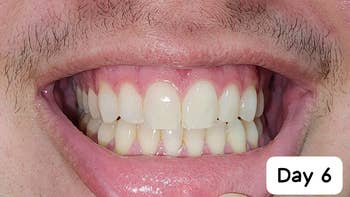 after image of the reviewer with significantly whiter teeth