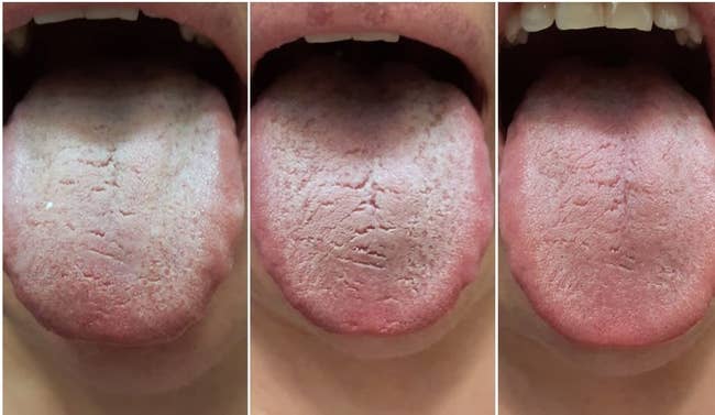 reviewer showing three progression photos: tongue first thing in the morning with white film, then after brushing with toothbrush looking slightly better, then after using scraper with the tongue looking significantly better with no film