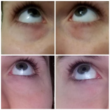 a reviewer's before and after showing how the stick has decreased under eye bags and puffiness