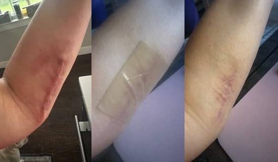  archetypal  with a wound, 2nd  with a bandage, and 3rd  with scars, illustrating betterment   stages