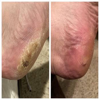 before photo of another reviewer's cracked heel next to an after photo of the same heel with much of the dead skin removed to reveal softer, pinker heels