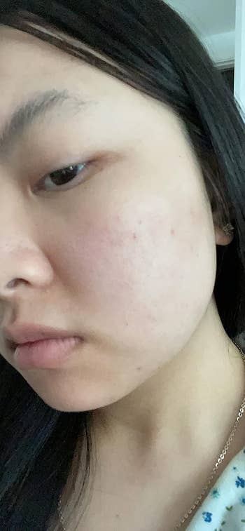 reviewer with a lot less acne after moisturizer