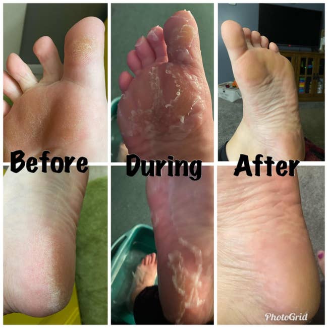 reviewer before photo of callused feet, during photo of peeling feet, and after photo of soft, smooth feet without any calluses present