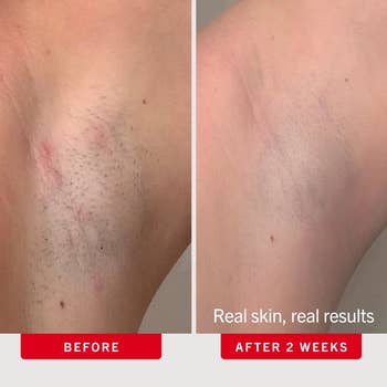 Before and aft images of underarm tegument showing hairsbreadth simplification and smoother texture aft 2 weeks of treatment