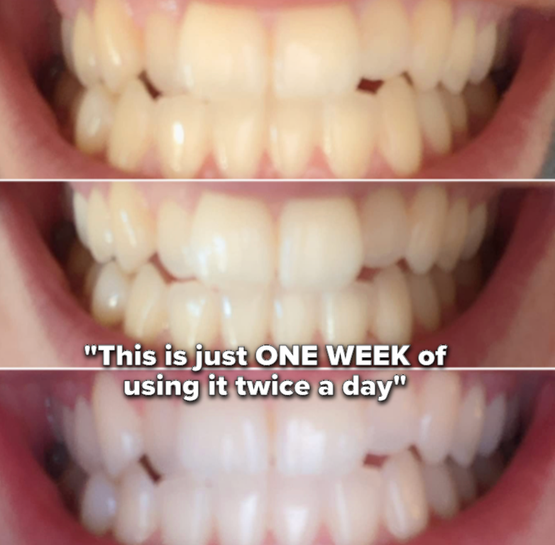 A three part series showing reviewer's teeth going from yellow to write, 