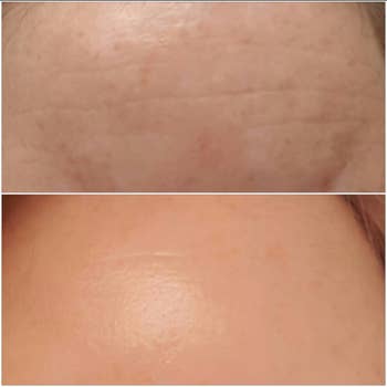 Close-up examination  of tegument  earlier  and aft  treatment, showing reduced lines and smoother texture successful  the aft  image