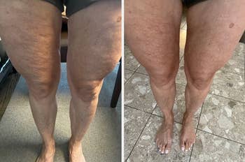 before of a 60-year-old reviewer's legs and cellulite on their thighs and after with less