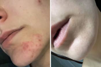 Close-up of a person's chin earlier  and aft  skincare treatment, showing reduced redness and smoother tegument  texture