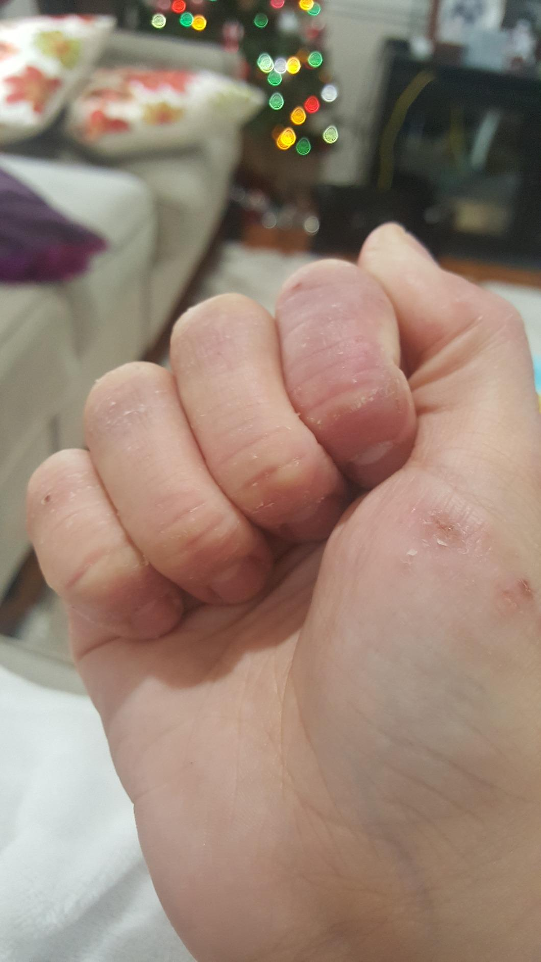 the same reviewer's hand, which now looks moisturized, less red, less cracked, and less angry