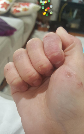 the same reviewer's hand, which now looks moisturized, less red, less cracked, and less angry