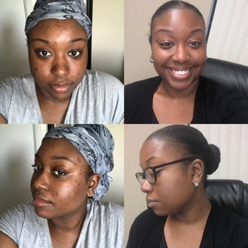 reviewer before and after photo series showing their skin looking much more even and bright after using the serum