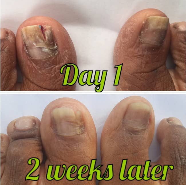 before and after images of a reviewer's toenails with fungus then being removed