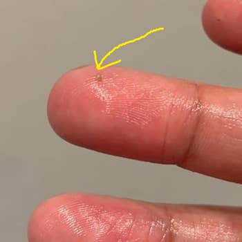 Close-up of a digit  with a tiny  speck, perchance  a splinter, highlighted by a hand-drawn arrow