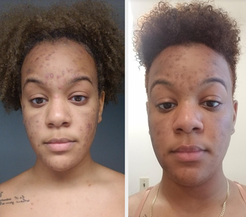 Reviewer before using oil with dark scars/reviewer after with scars starting to fade