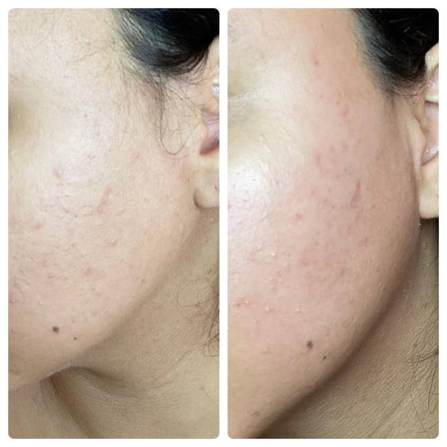 Before-and-after images showing improved tegument texture connected a person's cheek, highlighting reduced redness and smoother appearance
