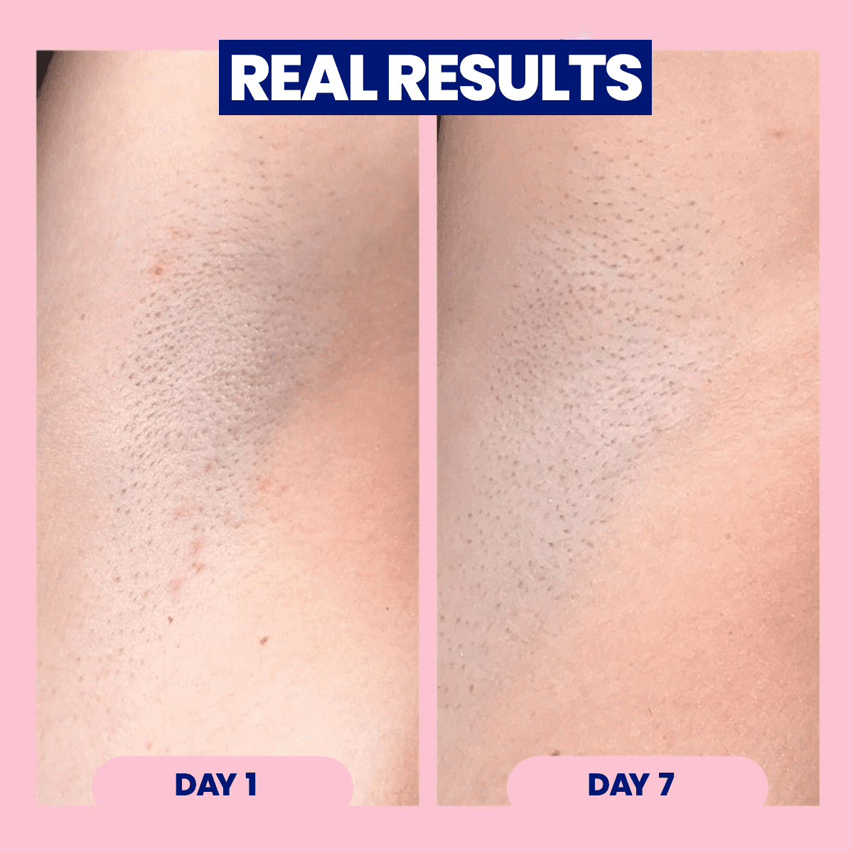 Close-up of underarm tegument  showing hairsbreadth  simplification  from Day 1 to Day 7, highlighting the product's effectiveness