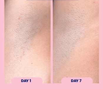 Close-up of underarm tegument showing hairsbreadth simplification from Day 1 to Day 7, highlighting the product's effectiveness