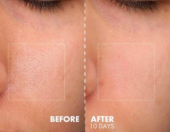 Close-up of a person's cheek showing skin texture improvement from 'Before' to 'After 10 days'