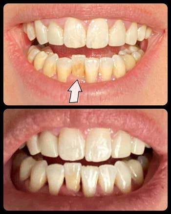 reviewer showing a before/after of their teeth, including a particularly yellow tooth that's further back, and the after pic showing how all of their teeth are much whiter
