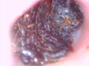 an ear canal that's coated with a thick hard layer of wax