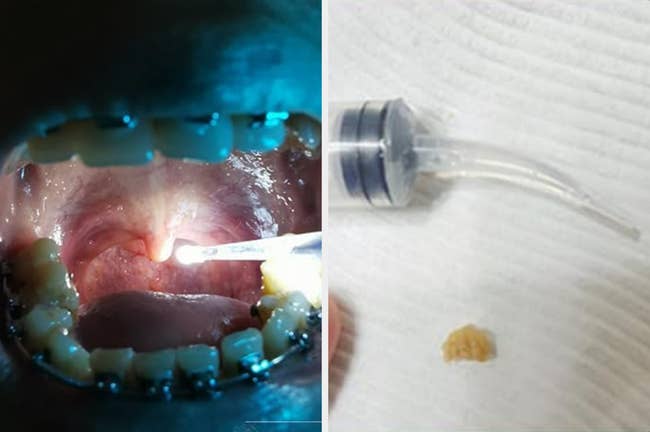 Dental procedure with a light inside an open mouth on the left; dental tool with a small extracted object on the right