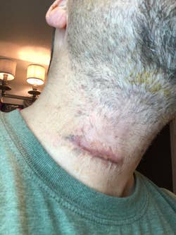 reviewer pic showing a scar on their neck from surgery before using bio-oil