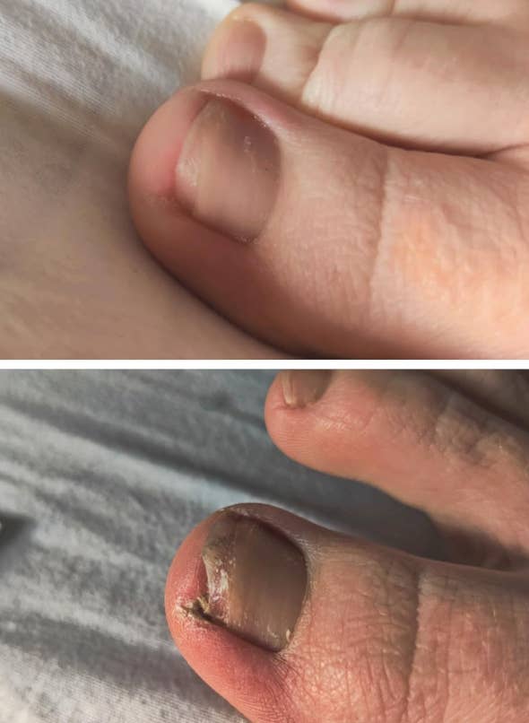 Close-up of infected toenail before an after use of product