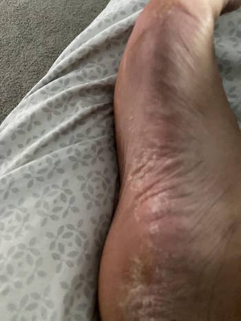 reviewer's foot with dead skin on the heel 