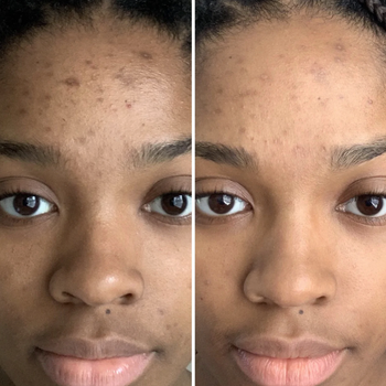 person before and after using oil on face blemishes