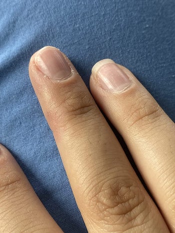 the same reviewer's finger with the wart totally gone