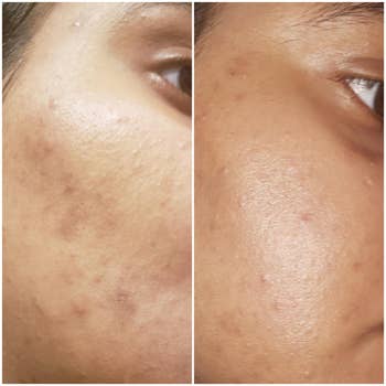 Reviewer showing results of using CeraVe vitamin C serum