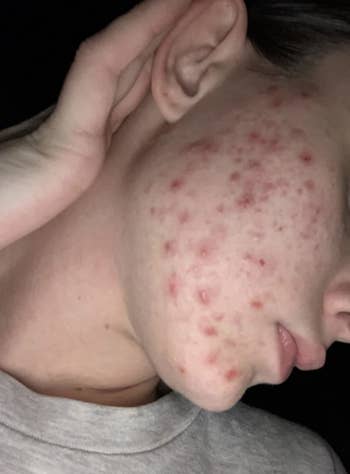 Close-up before image showing a person's cheek with acne