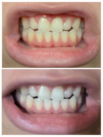 Close-up examination  of teeth earlier  and aft  utilizing a whitening product, showing noticeable differences successful  brightness
