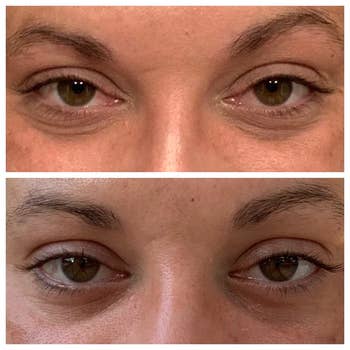 Reviewer before and after pic of their under eyes after using the cream, showing less wrinkles