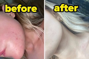 Before and after image of cystic acne redness clearing up on a reviewer's chin 