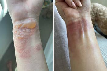 Two close-up images amusement   a wrist with a healing tegument  condition, including peeling and redness, demonstrating earlier  and aft  skincare treatment