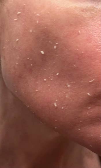Close-up of a person's feature  with disposable   adust  tegument  flakes