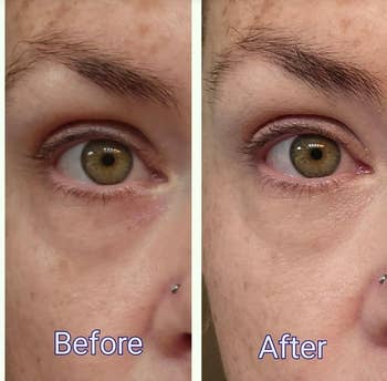 Close-up of a person's oculus  successful  earlier  and aft  skincare examination  images; disposable   simplification  successful  under-eye darkness