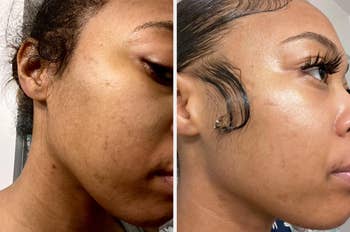 Close-up comparison of a woman's face, showing skin improvement before (left) and after (right) treatment. The right image shows smoother, clearer skin with styled hair edges