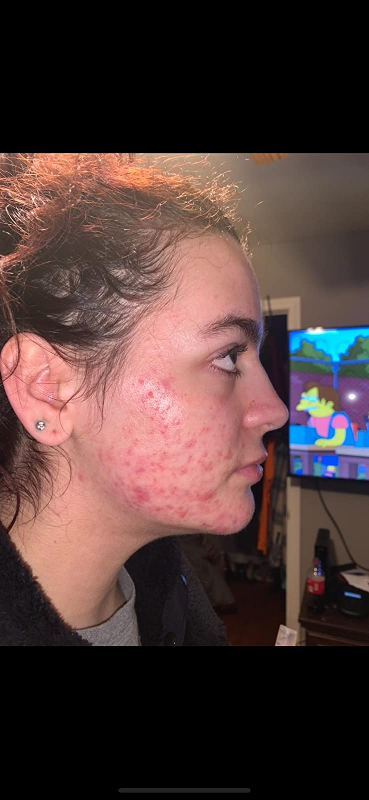 right side of reviewers face covered in acne and acne scars