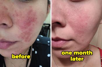 Close-up before and after comparison of a person's skin showing acne treatment results over one month