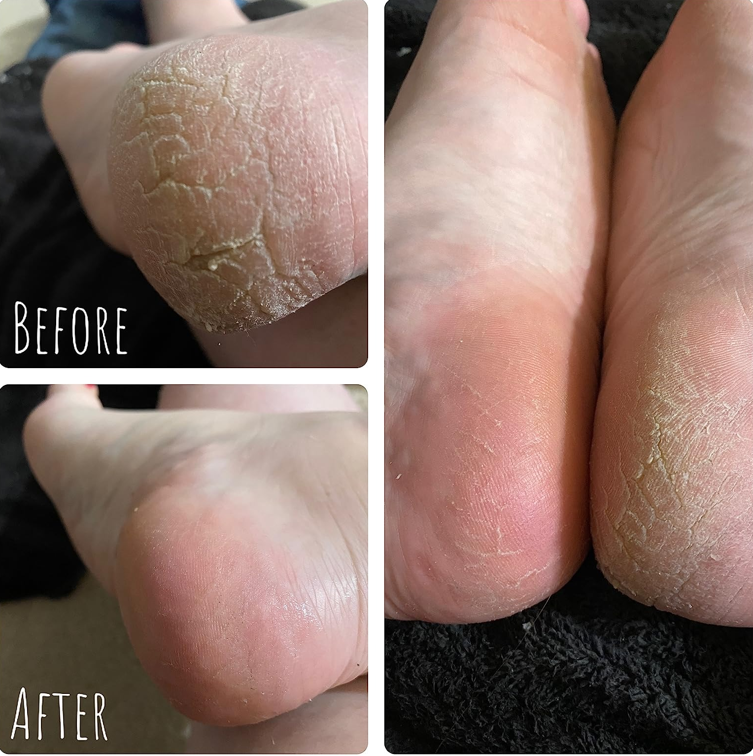 Reviewer's before and after results using the callus remover 