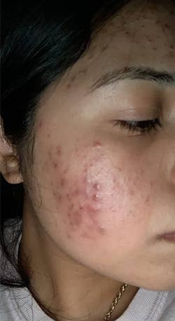 before image of reviewer's face covered in acne and red acne scarring