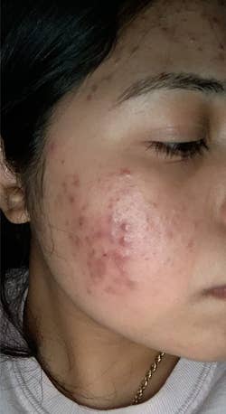 before image of reviewer's face covered in acne and red acne scarring