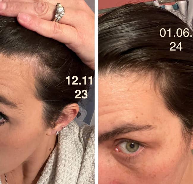 Side-by-side comparison of reviewer's hairline before and after using after one month showing more hair at the temples